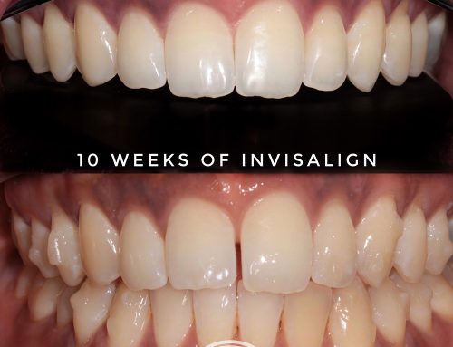 Invisalign Rugby