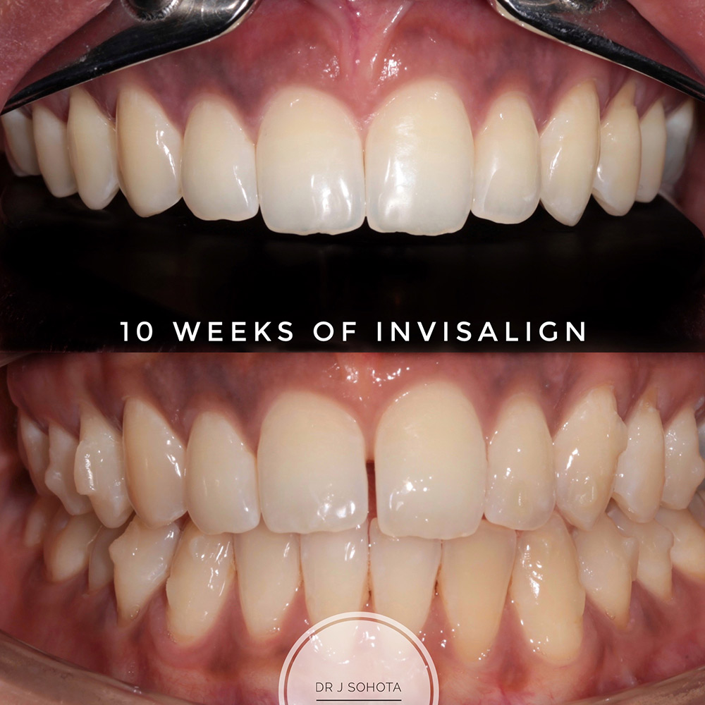 Invisalign