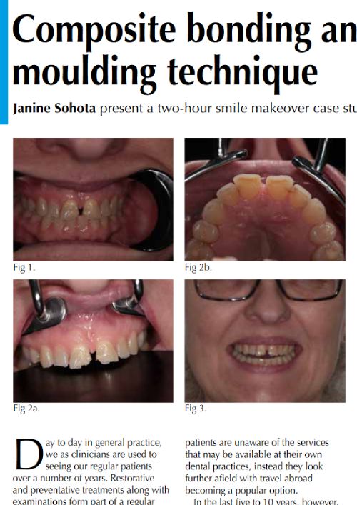 Composite Bonding